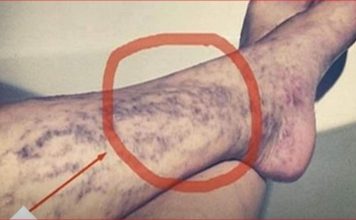 Svatko kod kuće ima lijek za popucale kapilare, ali mnogi ljudi to ne znaju! Svatko kod kuće ima lijek za popucale kapilare, ali mnogi ljudi to ne znaju! - featured image